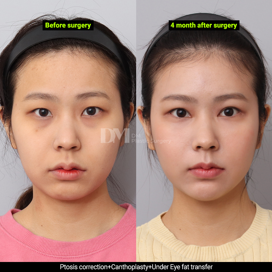 /images/en/Eyes_EyesSurgery/plastic surgery in korea_eyes surgeryBA03.jpg